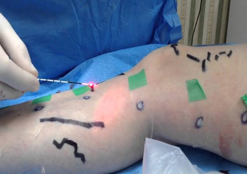 Latest Varicose Veins Treatments available in Miyapur, hyderabad