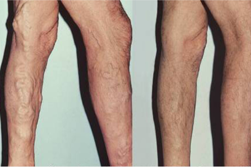 Varicose Veins Laser Treatment in Miyapur, Hyderabad