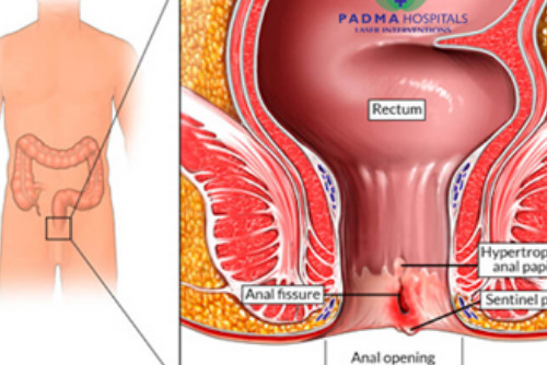 Anal Fissures Laser Treatment in Miyapur, Hyderabad