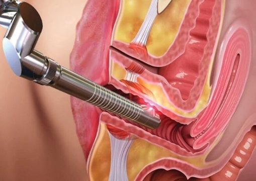 Laser vaginoplasty in Miyapur, Hyderabad